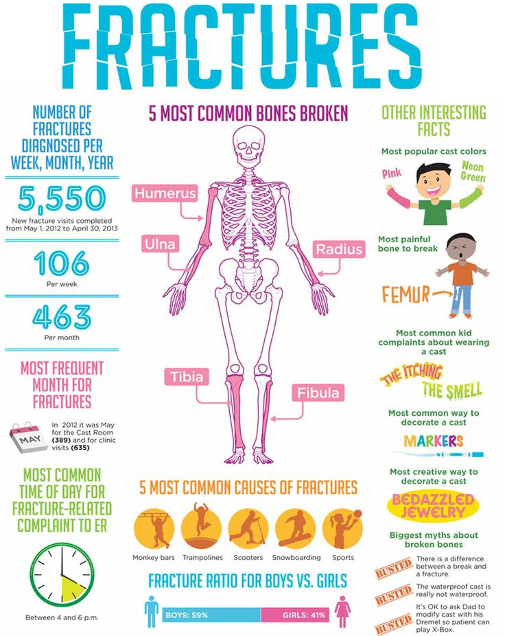 5 Most Common Bone Fractures for Kids - Sports & Spine