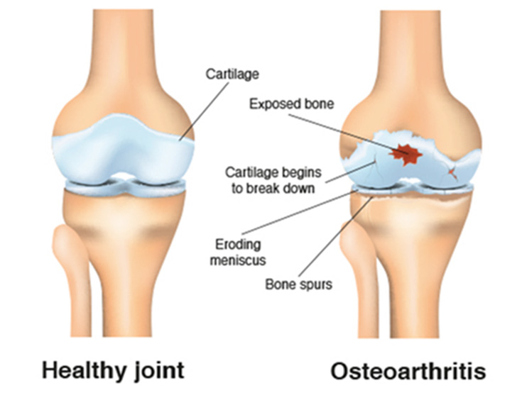 Comparison Between a Healthy Knee Joint and Knee Osteoarthritis