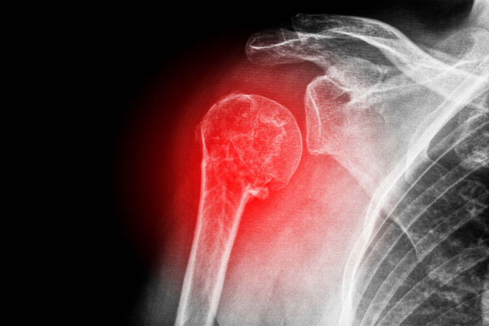 Should You Pop a Dislocated Shoulder Back in?